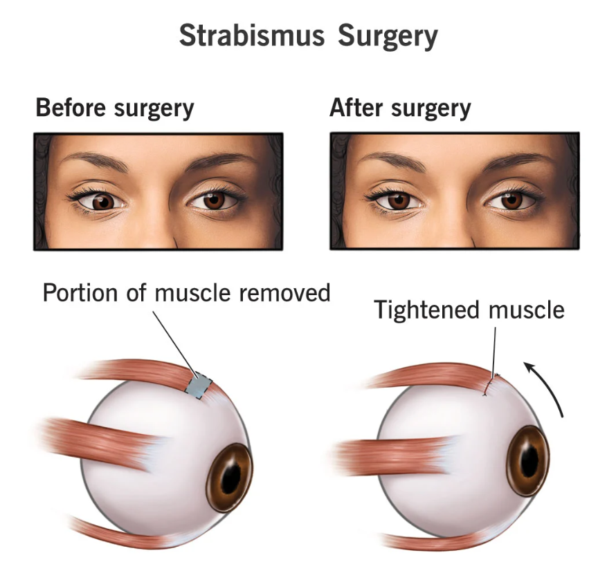 Strabismus Surgery